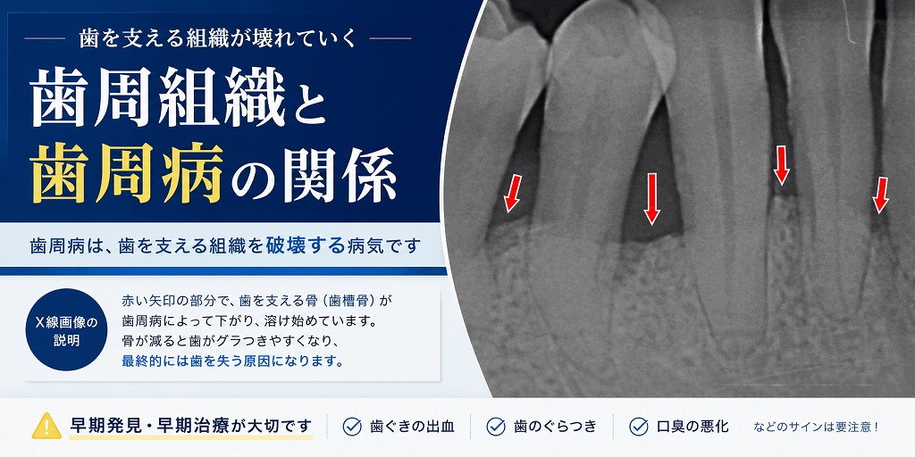 赤い矢印の部分で、歯を支える骨が歯周病によって下がり、溶け始めています。骨が減ると歯がグラつきやすくなるため、早めの治療が大切です。