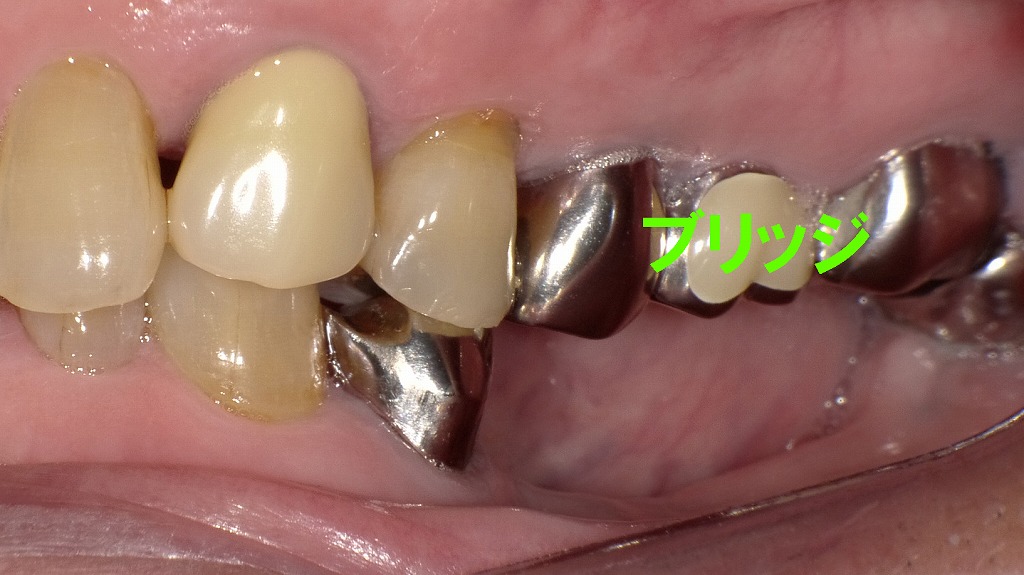 上顎5・6・7番がブリッジで連結されている症例