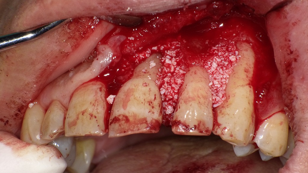 上顎前歯部に人工骨を填入した歯周組織再生治療