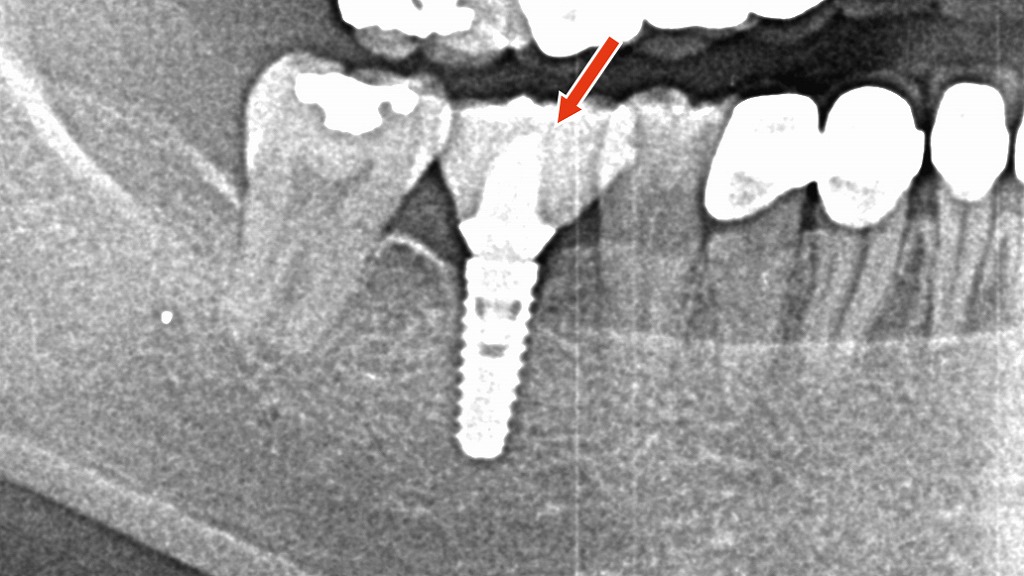 インプラントのパノラマレントゲン画像