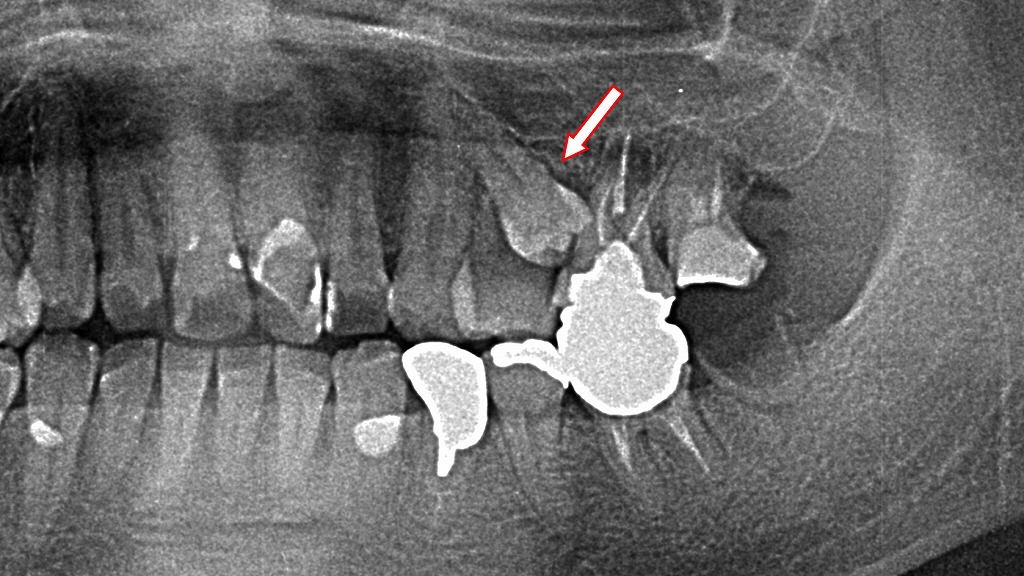 小臼歯が埋伏歯となったレントゲン画像
