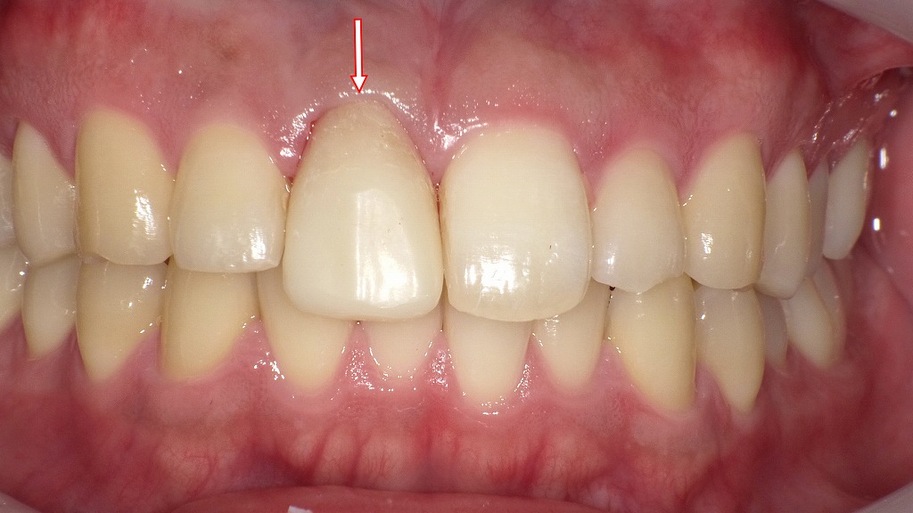 オールセラミッククラウンの症例
