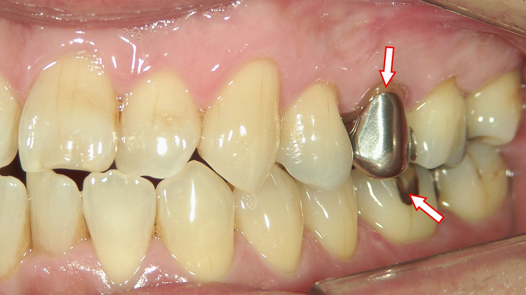 保険診療の金属の補綴物(銀歯)