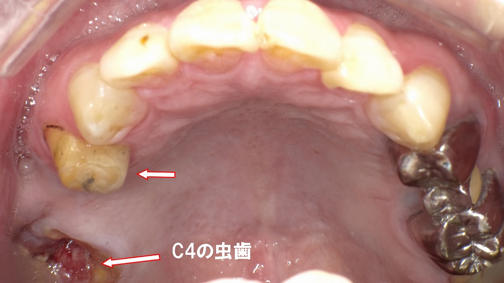 保険のブリッジが脱離（咬合面観）
