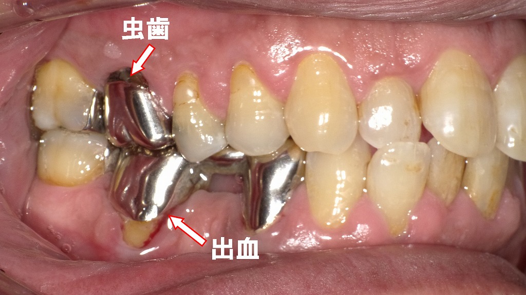 寿命を迎えつつある銀歯の症例