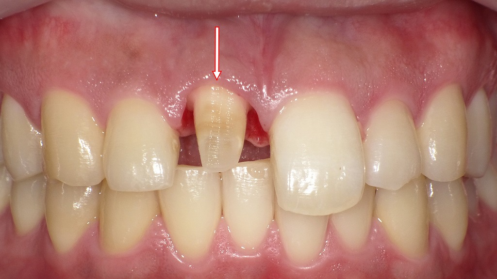 ファイバーコアを装着