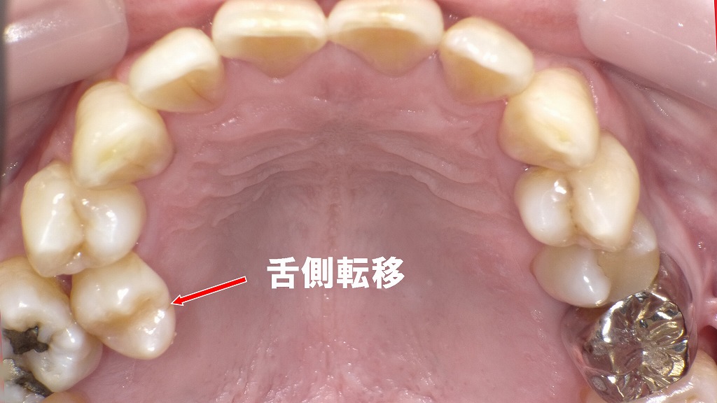第二小臼歯が舌側へ転移し、歯列の内側に倒れ込んだ状態