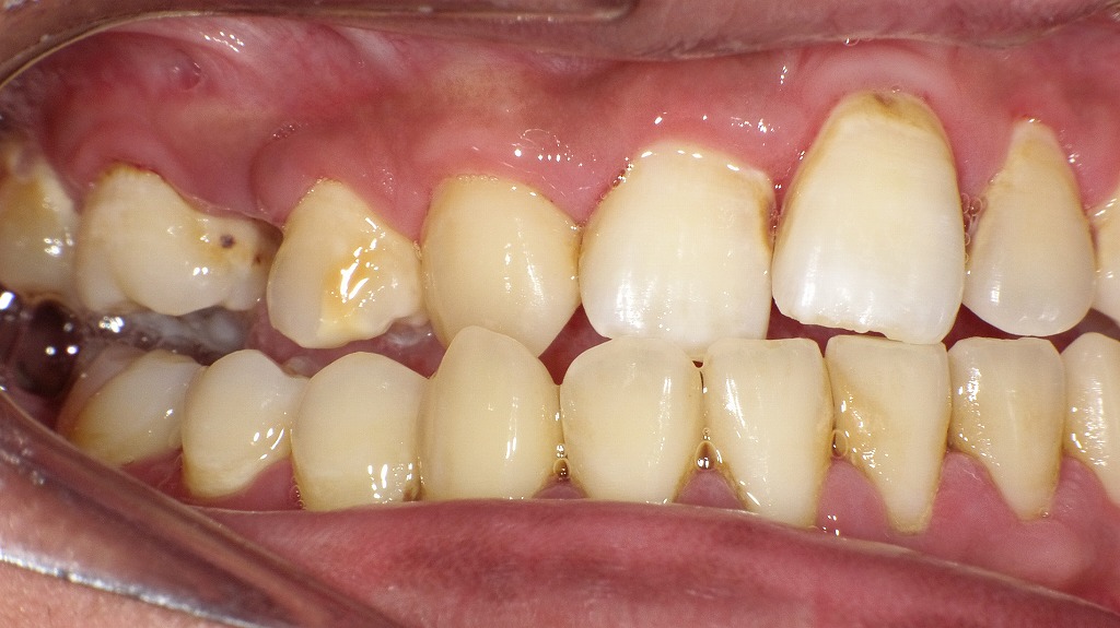 頬が腫れる原因は歯ぐきの炎症？進行した歯周病・歯槽膿漏のサイン