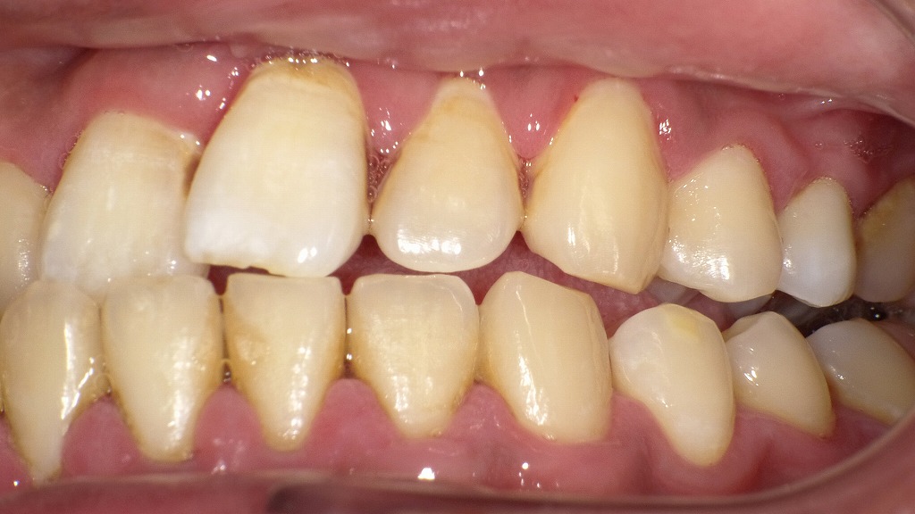 歯周病の進行度 P1〜P4:歯ぐきの変化からわかるサイン