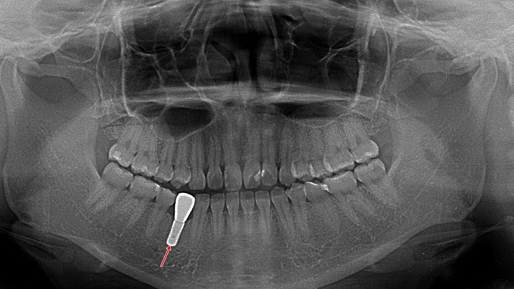 下顎４番にインプラント