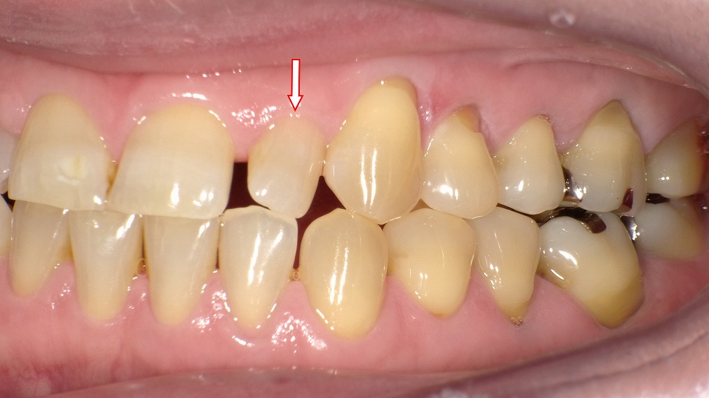 左側面観：歯が小さい症例