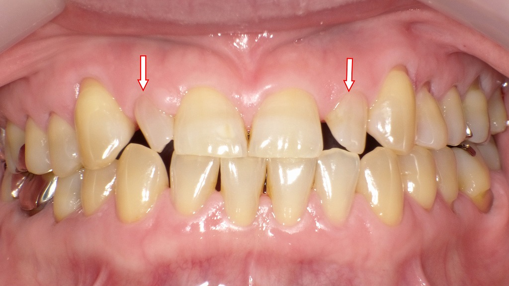 正面観：歯が小さい症例