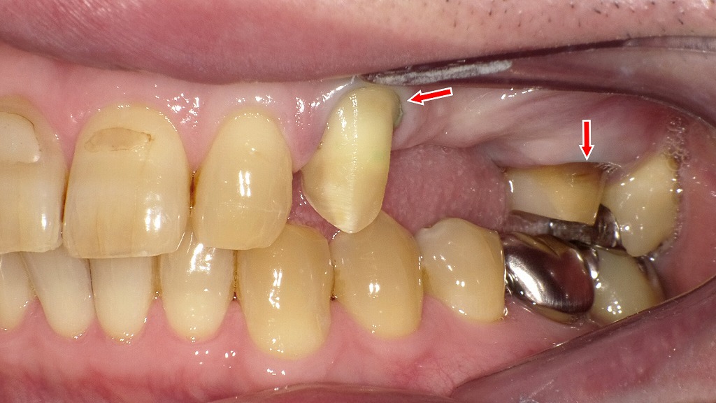 上顎右側臼歯部から前歯部を側方面観で撮影した口腔内写真