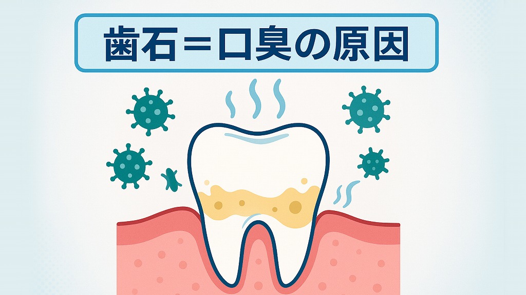 歯石が原因の口臭とは?