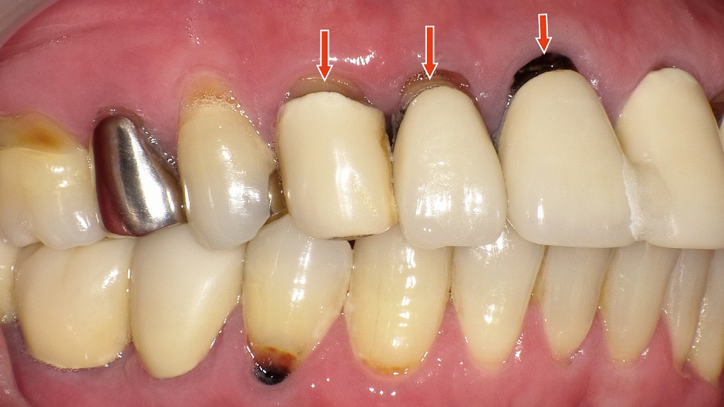メタルボンド冠にブラックマージン