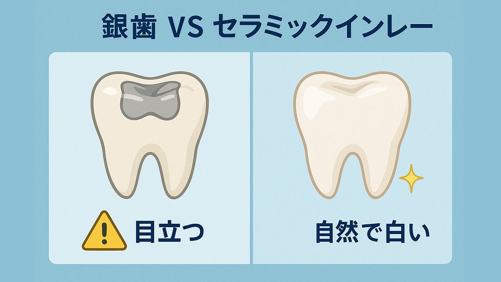 セラミックインレーと銀歯との違い