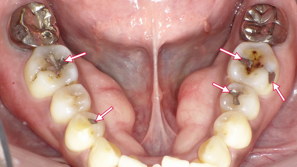 矢印の部位はすべてアマルガム充填です。左下6番の詰め物が一部脱離し、その部分に二次カリエスが発生しています。