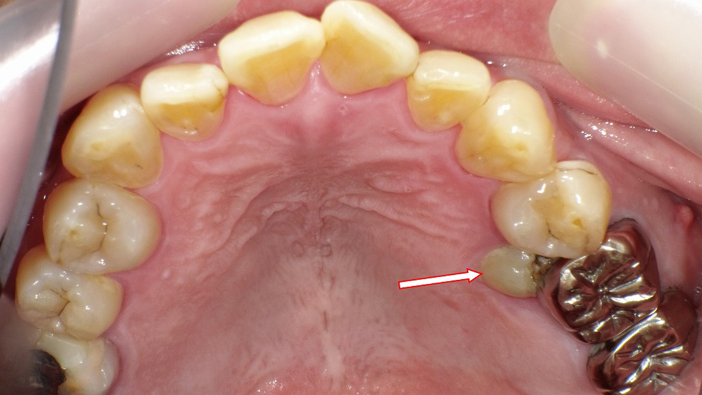小臼歯が埋伏歯となった口腔内写真