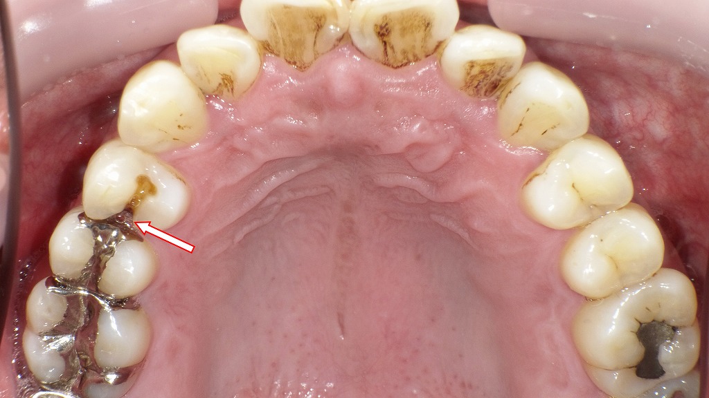 銀歯が取れて放置した症例