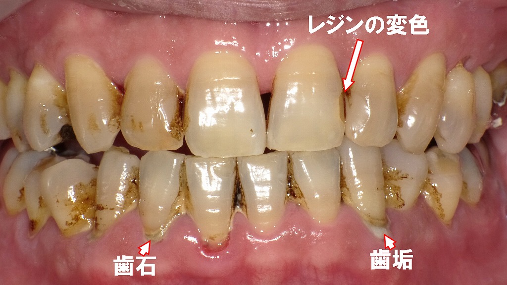 術前：歯科医院でのヤニ除去症例