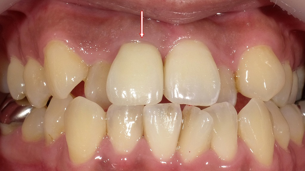 メタルボンドクラウンを装着