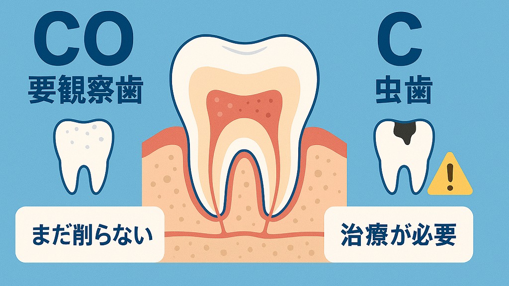 COと虫歯(C)の違い