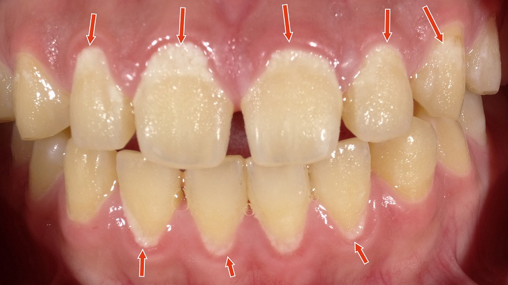 大量の歯垢（プラーク）による酸の刺激