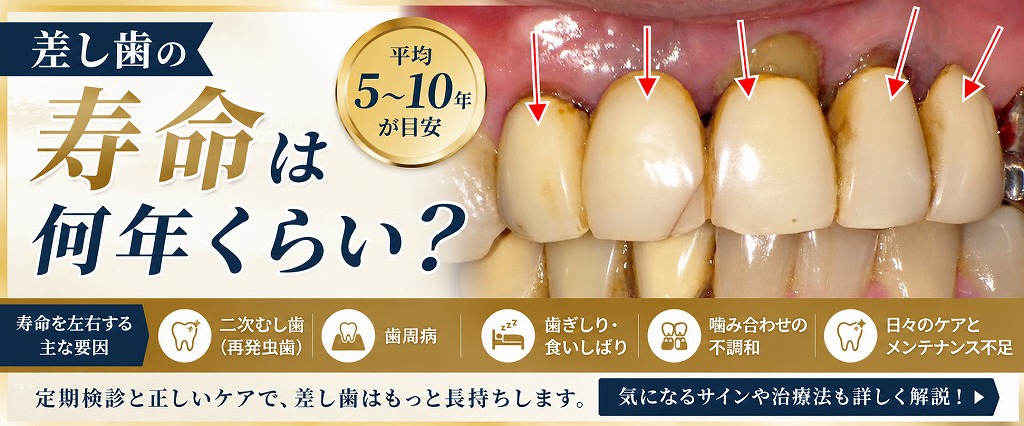 差し歯の寿命は何年くらい？