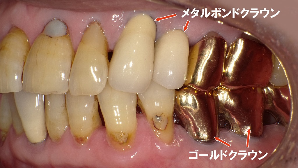 メタルボンドクラウンとゴールドクラウン