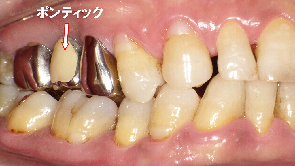 保険適用の銀歯（ブリッジ）