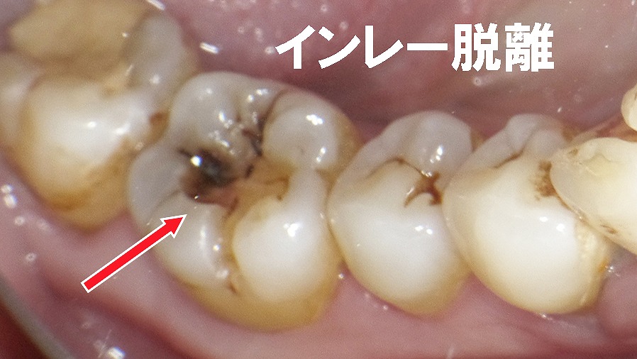銀歯が取れて放置すると…インレー脱離から始まる再度の虫歯
