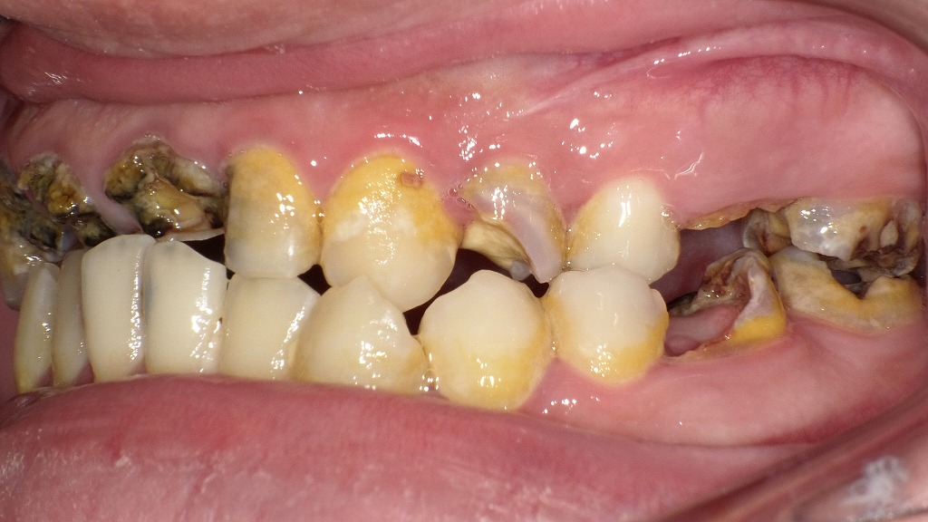 歯が崩壊するほど進行した黒い虫歯｜抜歯が検討される状態