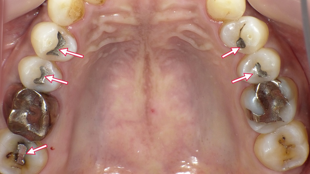 矢印の部位はすべてアマルガム充填です。右上7番の歯に二次カリエスが発生しています。
