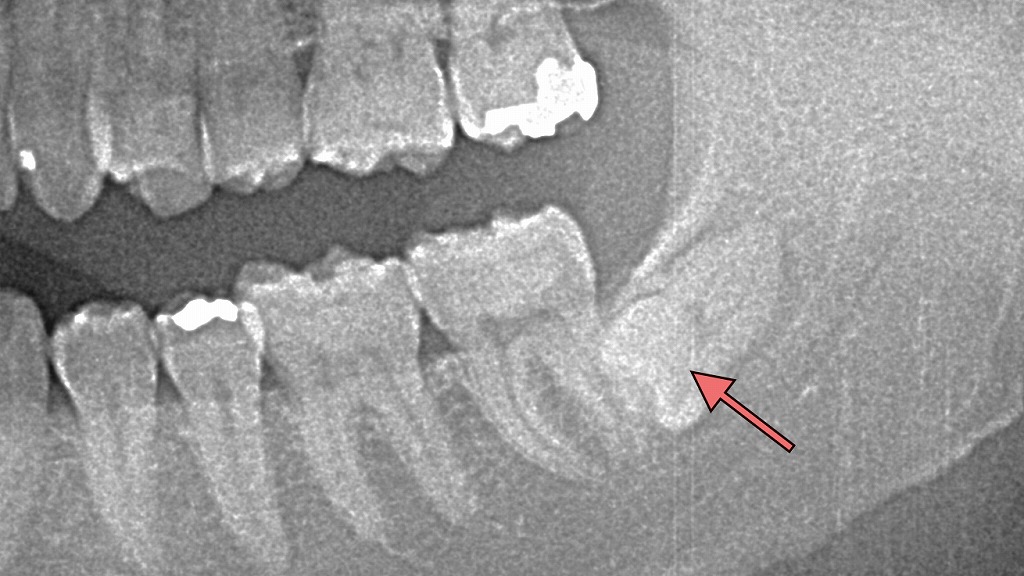 親知らずが埋伏歯となったレントゲン画像