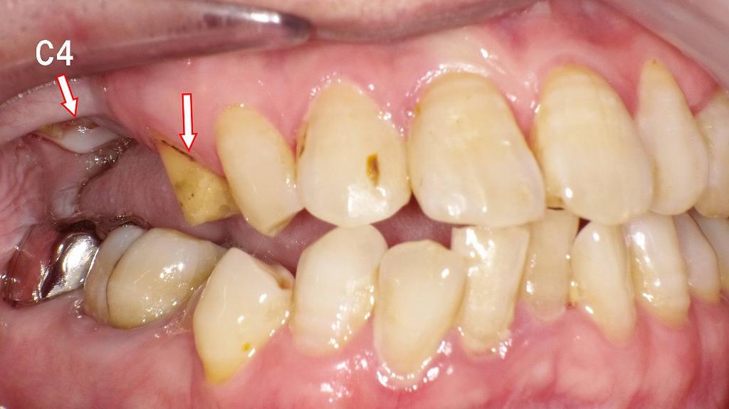 保険のブリッジが脱離（側方面観）