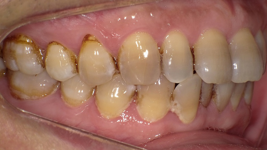 【術前】歯の表面にステインとプラークが広がり、口の中がベタついて気持ち悪い状態。