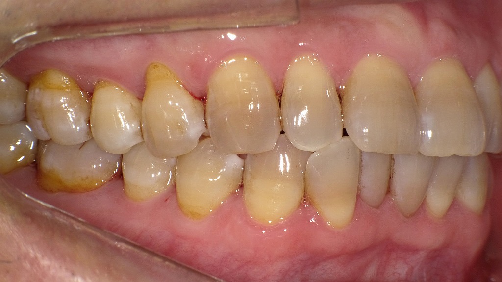 【術後（エアフロー後）】エアフローで汚れを一気に除去。歯面がツルツルになり、口の中がスッキリ爽快に。