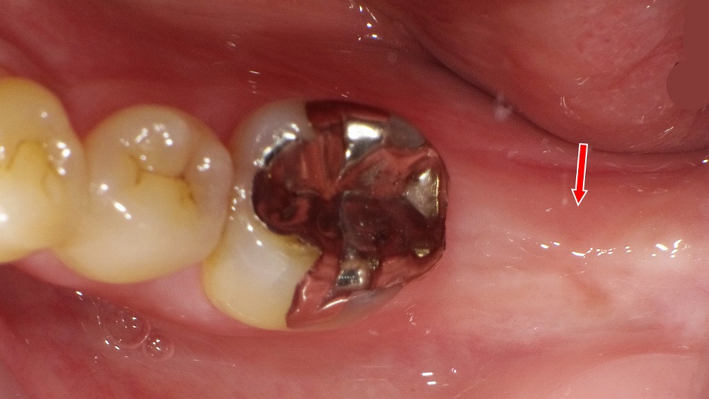 下顎7番抜歯後に生じる歯肉変化と上顎7番挺出のリスク