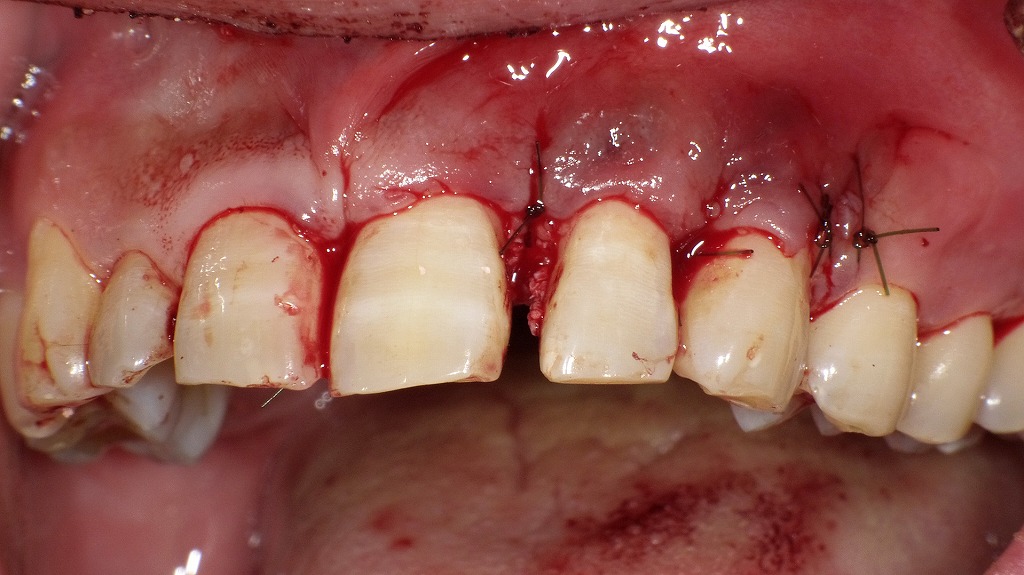 上顎前歯部の歯周外科手術（フラップ手術・再生療法）後に縫合
