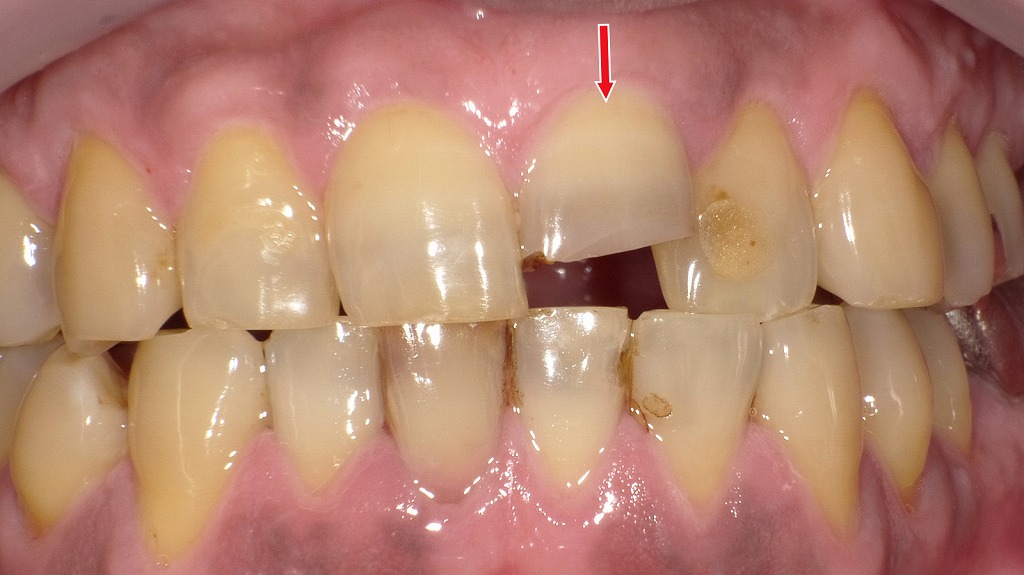 前歯が折れたときの治療例 ― コンポジットレジンでの修復可能