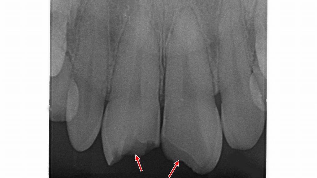 外傷によって歯が折れた症例（前歯の歯冠破折）