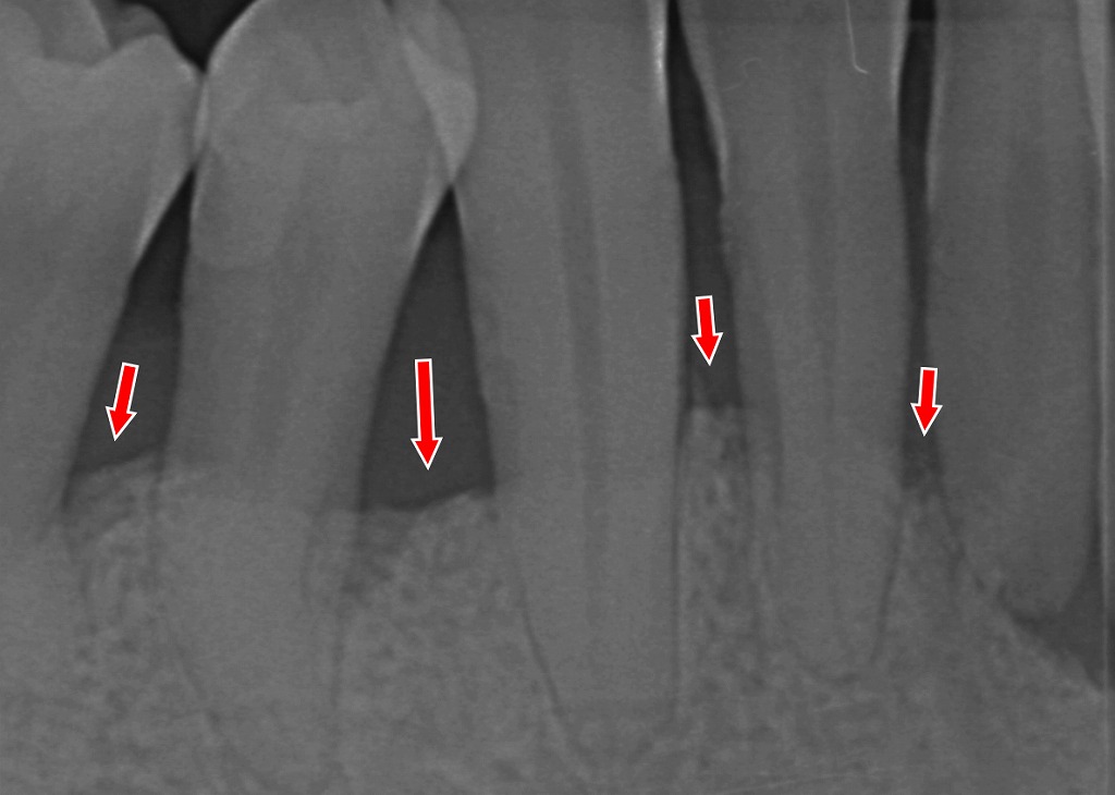赤い矢印の部分で、歯を支える骨が歯周病によって下がり、溶け始めています。骨が減ると歯がグラつきやすくなるため、早めの治療が大切です。