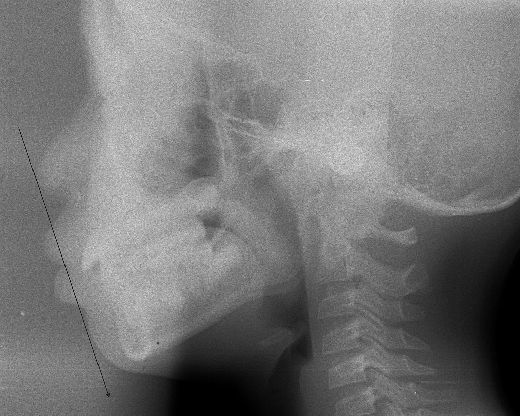 鼻呼吸がつくる美しい横顔｜口呼吸との違いでわかる見た目の変化