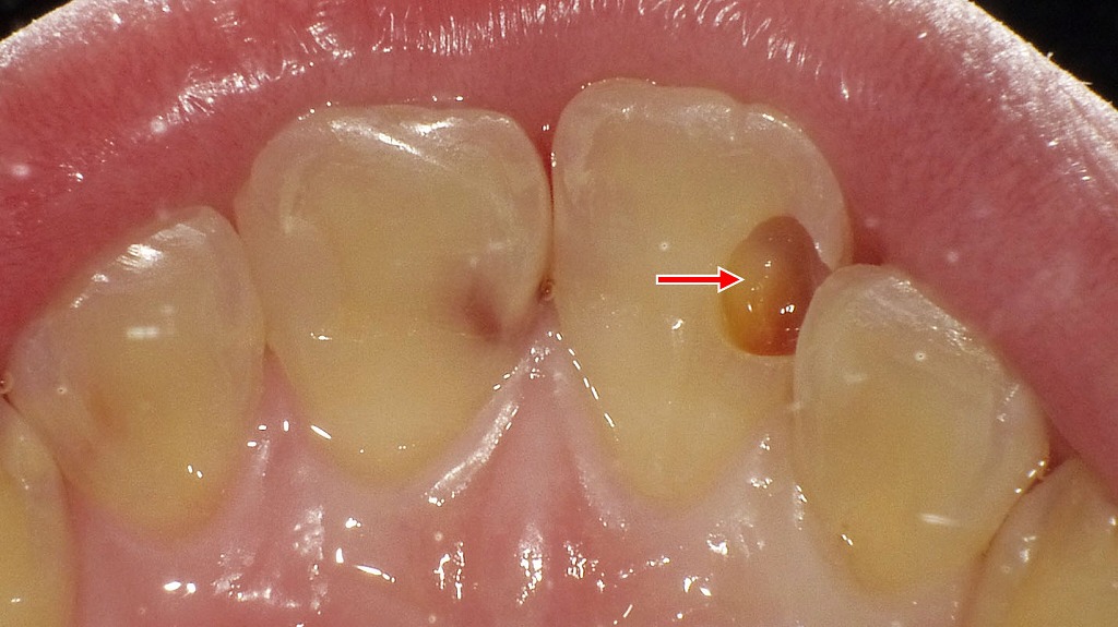 上顎1番に認められるC2虫歯（やや大きめのう蝕）