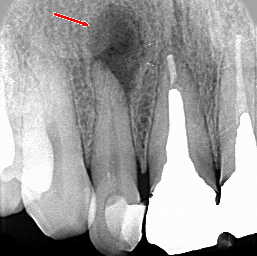 上顎2番根尖部に境界明瞭な透過像を認め、歯根嚢胞が疑われる所見。