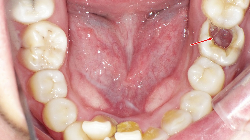 下顎6番に大きな穴 ― 重度の虫歯が進行した状態
