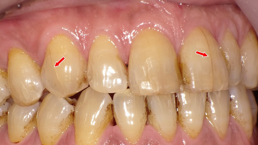 歯に入ったヒビ（クラックトゥース）
