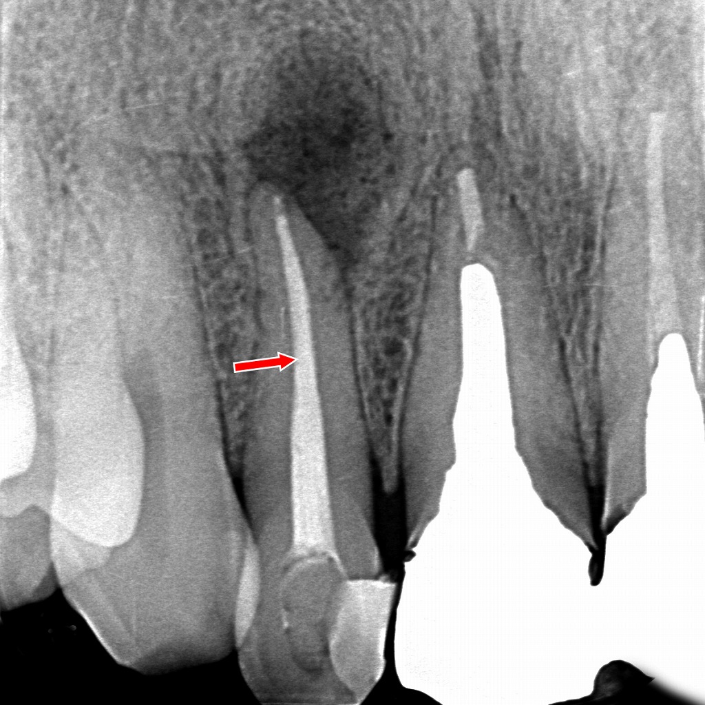 上顎2番の根管治療後。根尖まで適切に根管充填され、感染源の除去が完了した状態。