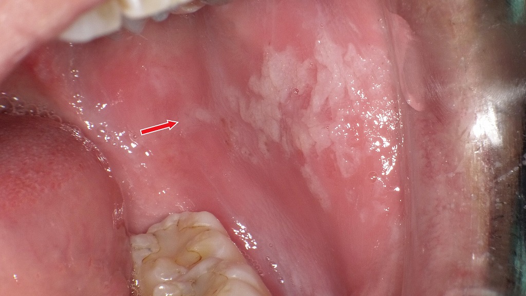 頬粘膜にみられる白板症の典型所見