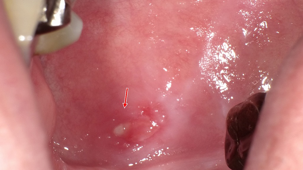 喉の奥のアフタ性口内炎
